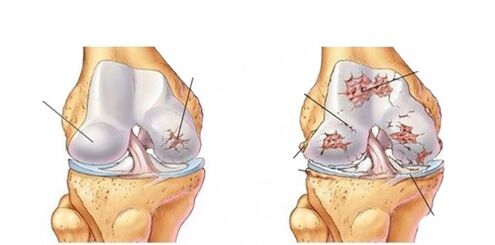 deformující artróza kolena