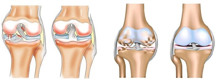 Rozdíl mezi artritidou (vlevo) a artrózou (vpravo) kloubů