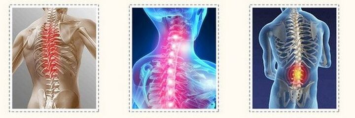osteochondrosis různé páteře