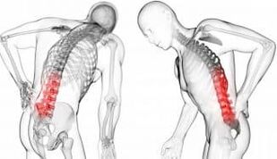 Intervertebrální kýla - komplikace s osteochondózou