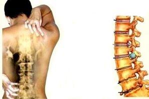 Bolest zad v různých stádiích vývoje cervikální osteochondózy