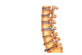 Poškození páteře s cervikální osteochondrosou