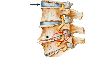 normální a poškozená páteř s cervikální osteochondózou