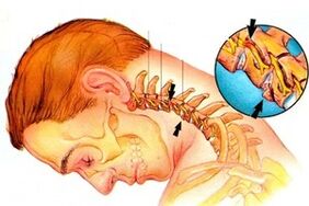 štípání nervu v páteři s cervikální osteochondózou