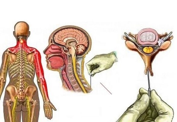 léčba cervikální osteochondrózy akupunkturou
