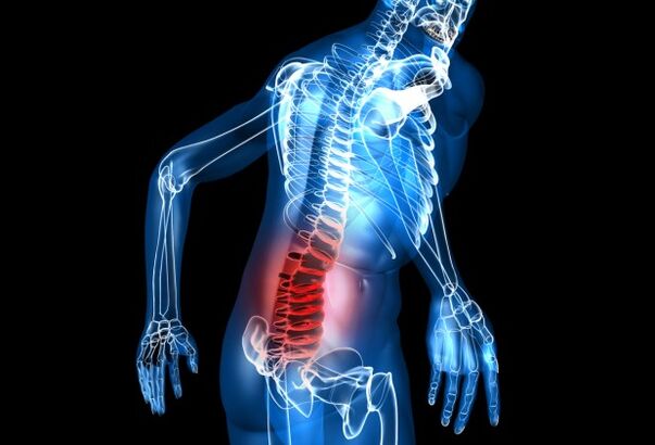 co je bederní osteochondróza