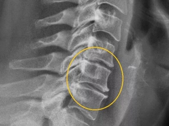 Osteochondróza krční páteře na rentgenu